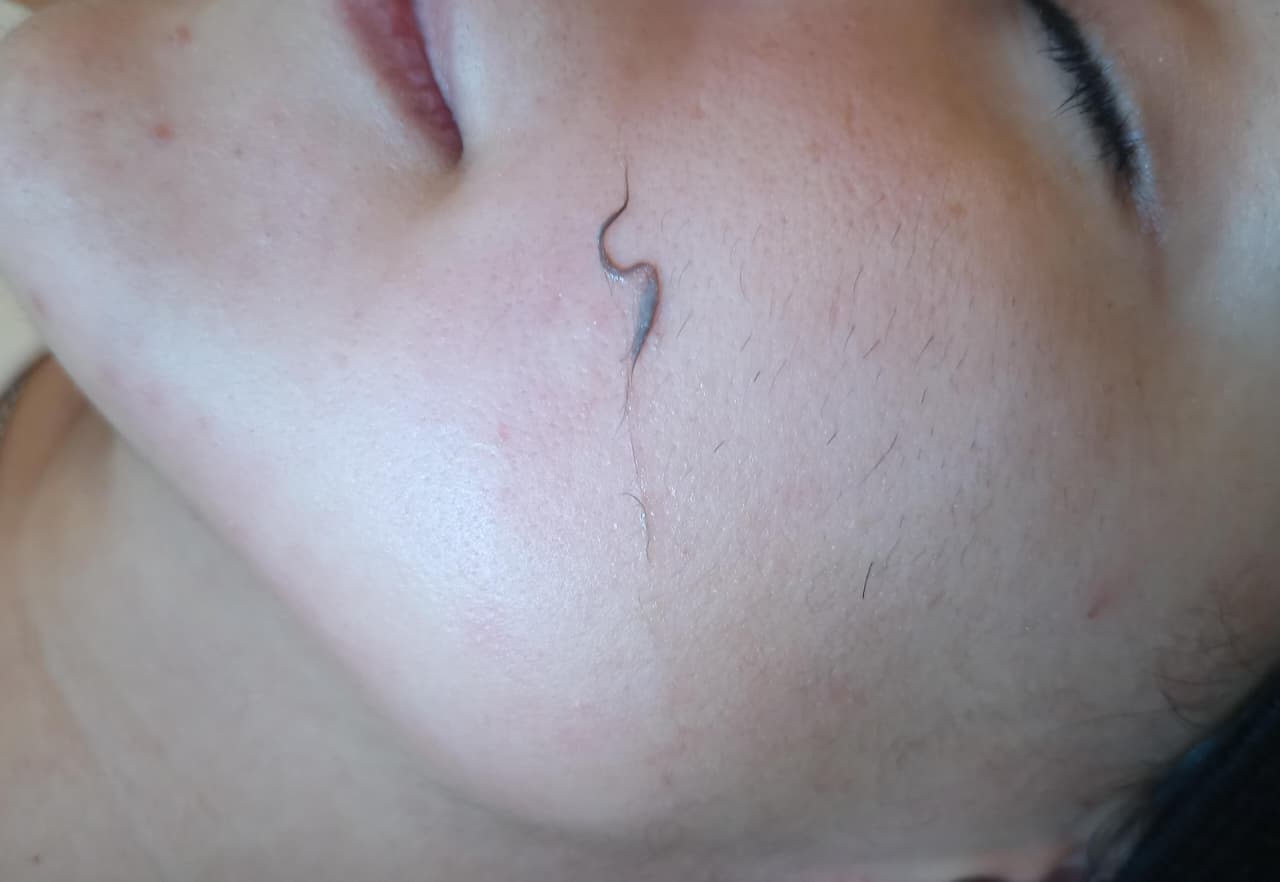 Dermaplaning
