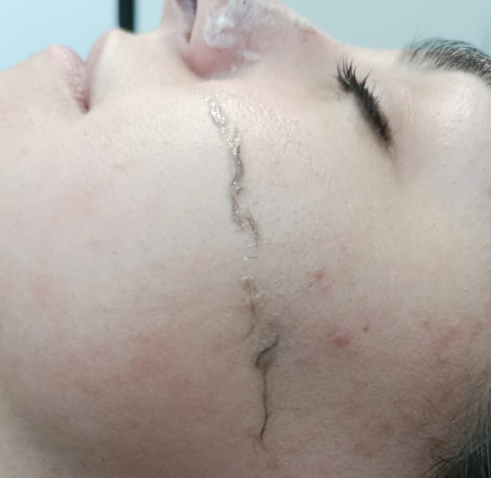 Dermaplaning