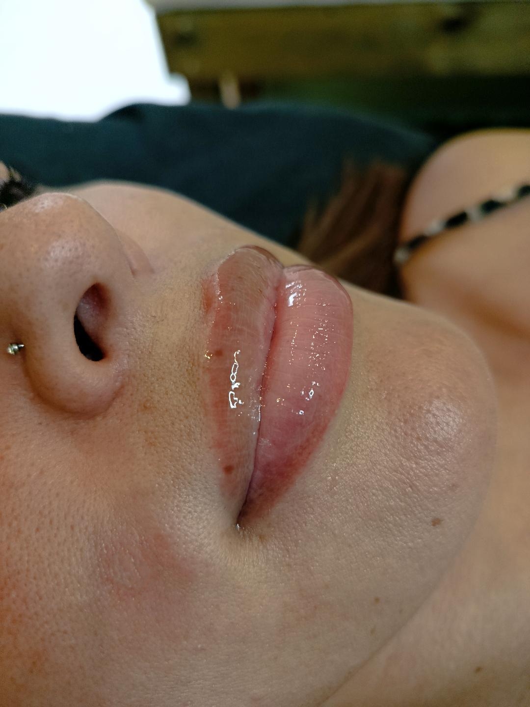 Hydralips con microneedling