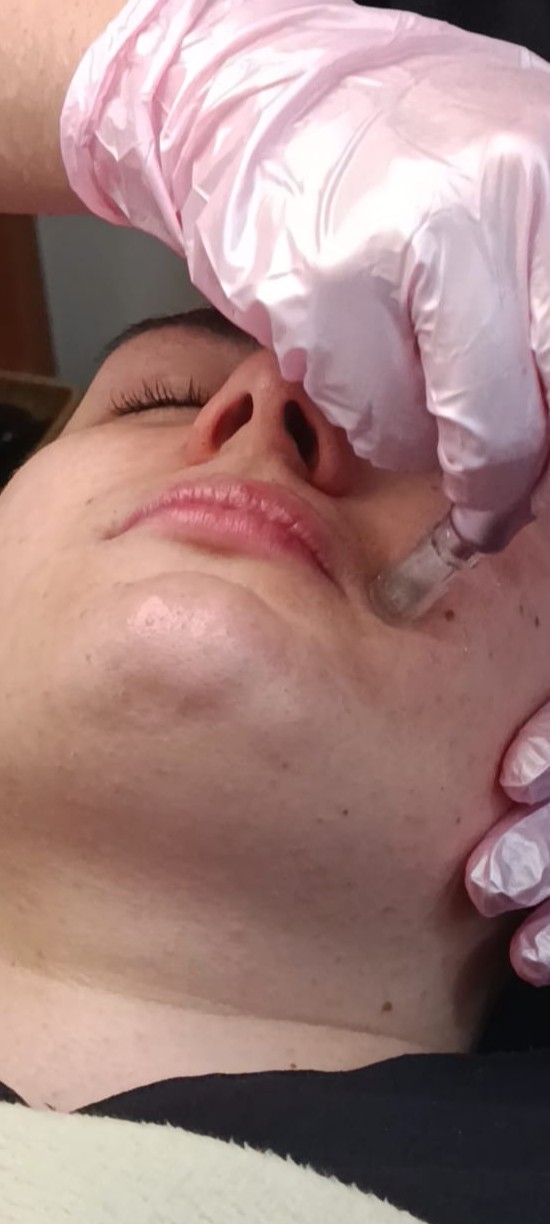 Renovación celular pro (microneedling)